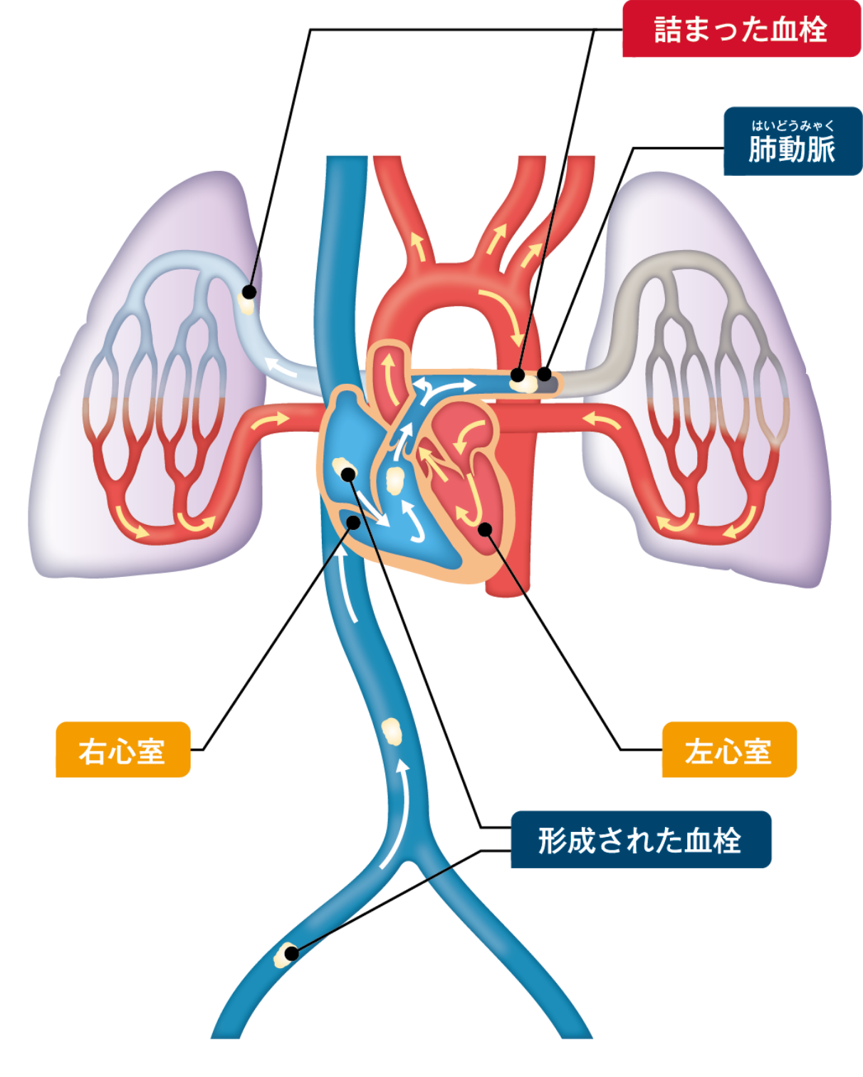 肺の⾎管に⾎栓が詰まるメカニズム