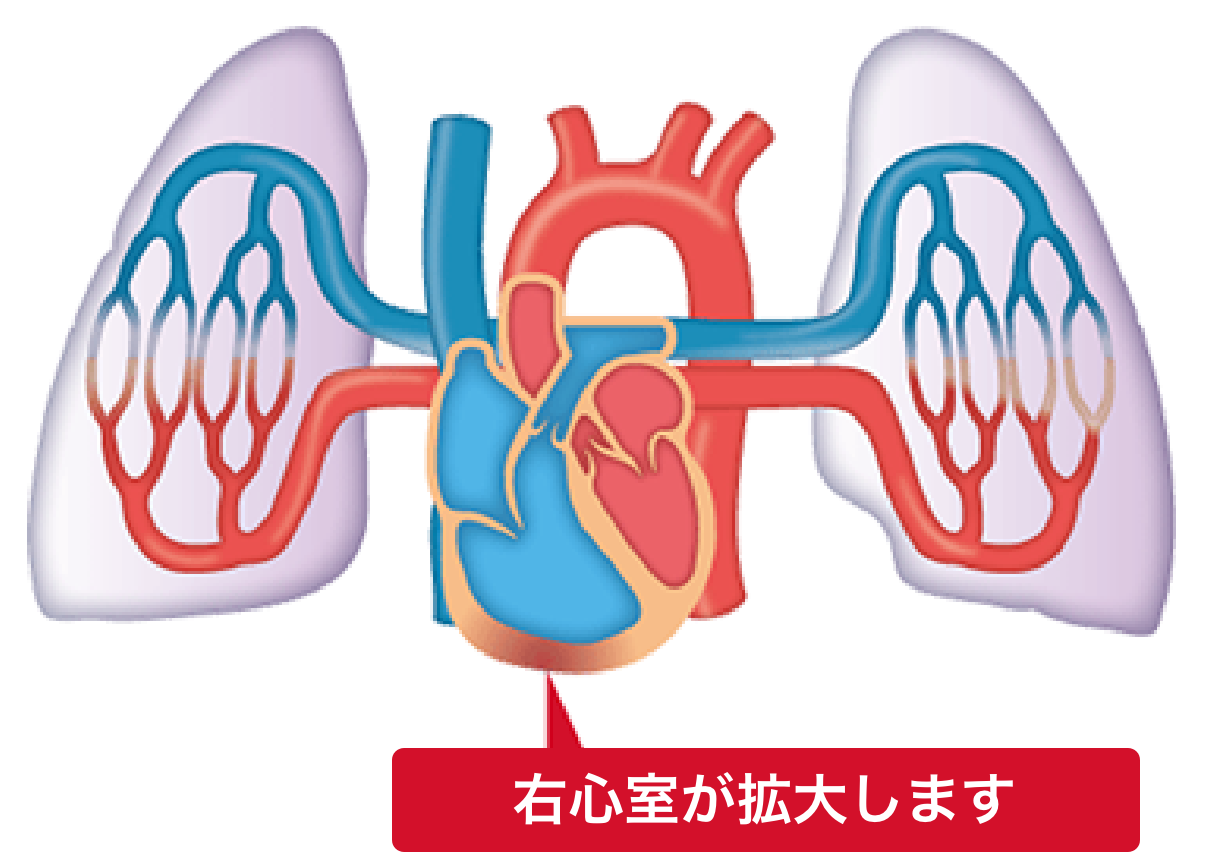 右⼼拡⼤