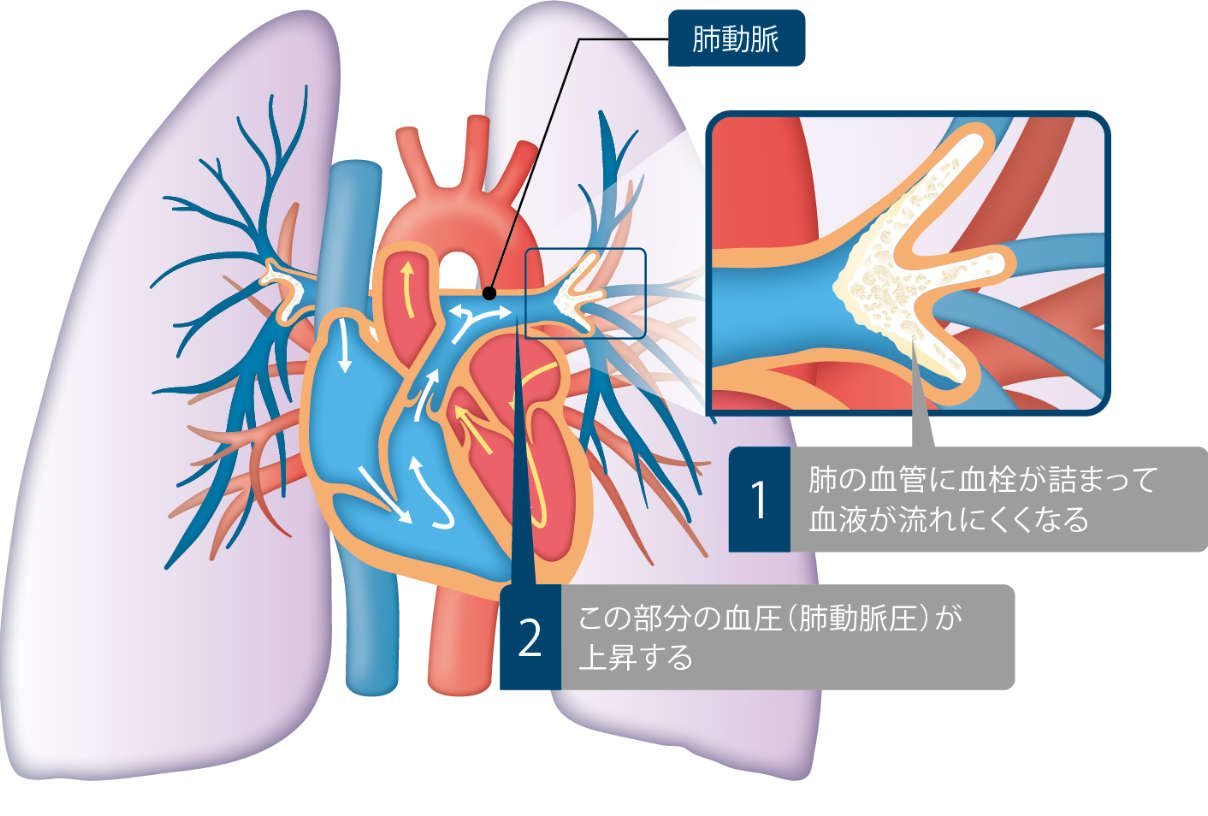 CTEPHが起こる理由