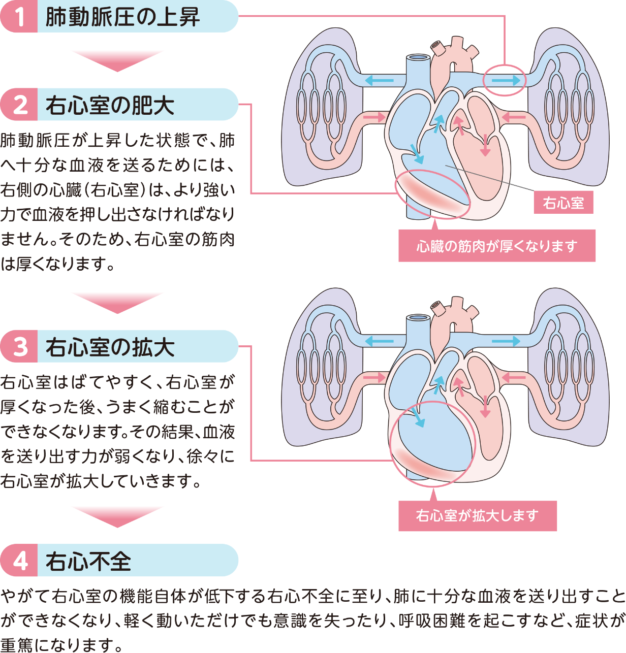 PAHの進⾏によるさまざまな症状