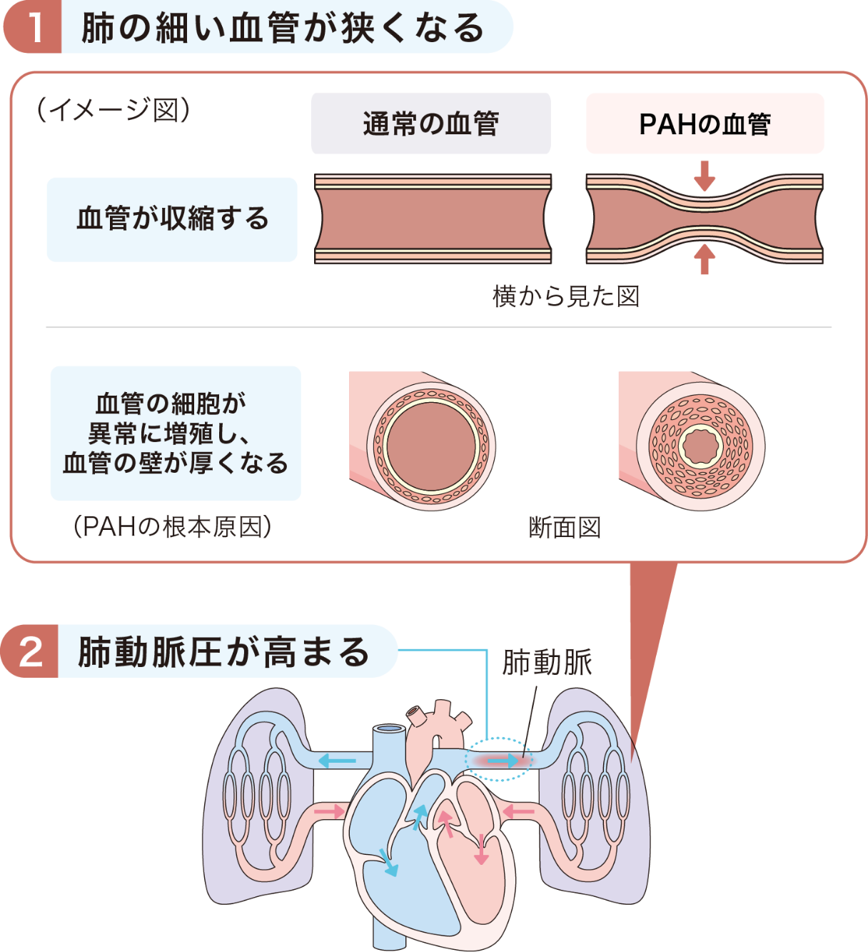 肺動脈性肺⾼⾎圧症の根本原因