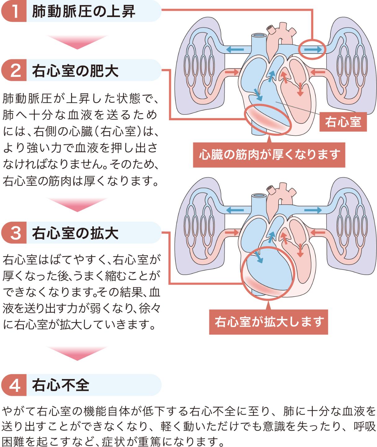 PAHの進⾏によるさまざまな症状